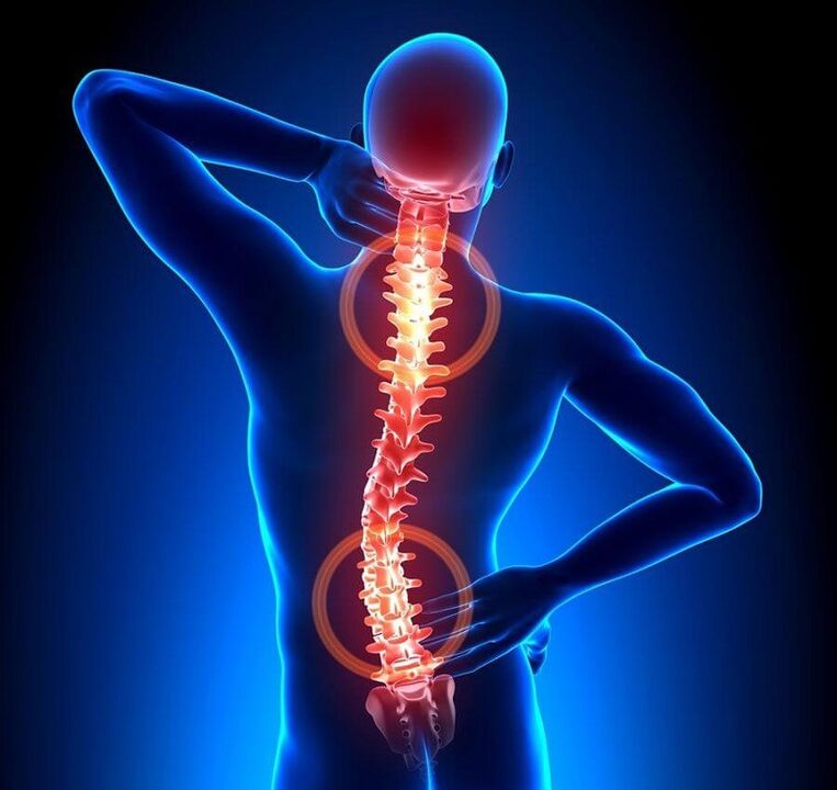 Osteocondrosis de la columna como causa de dolor de espalda. 