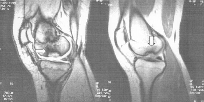 Radiografía de osteocondritis disecante en la articulación de la rodilla