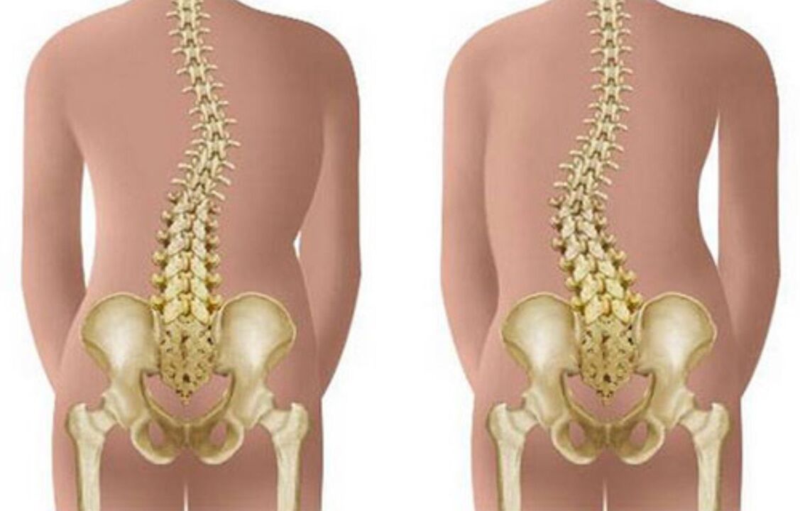 La escoliosis como causa de dolor de espalda en la zona del omóplato