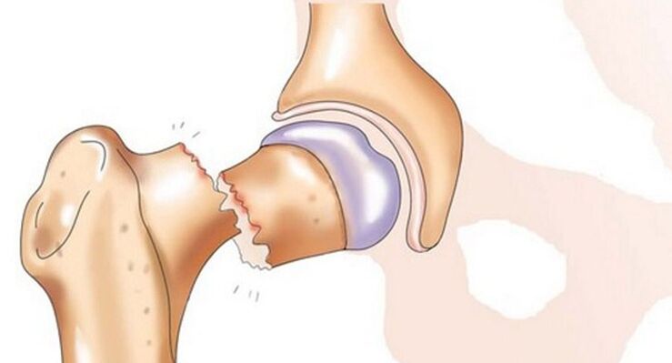 Una fractura del cuello femoral se asocia con un dolor intenso en la articulación de la cadera. 