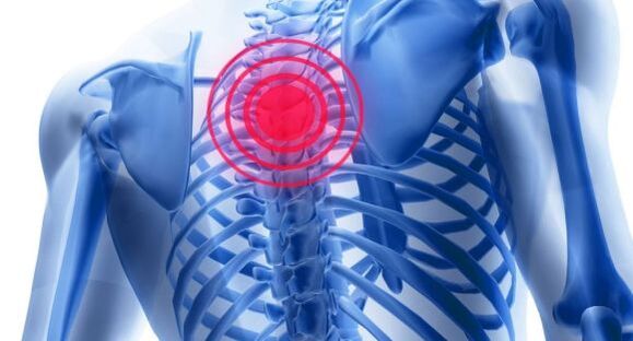 Tratamiento de la osteocondrosis de la columna torácica