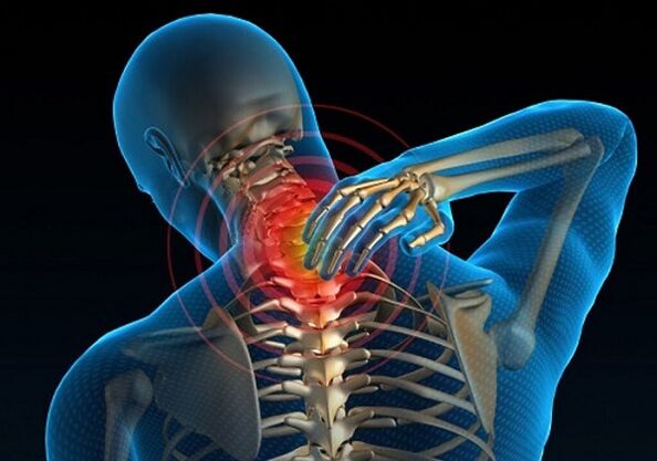 Dolor de cuello debido a osteocondrosis.