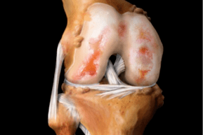 Daño en la articulación de la rodilla debido a la osteoartritis.