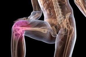 Dolor en las articulaciones debido a la osteoartritis de rodilla.