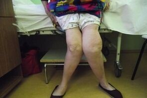 osteoartritis avanzada de la articulación de la rodilla