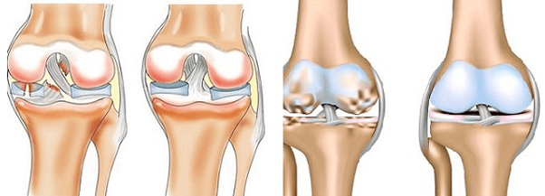 Artritis y artrosis